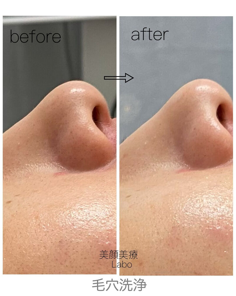 ☆毛穴洗浄 ハイドロスプラッシュ☆ | ブログ | 横須賀のエステなら