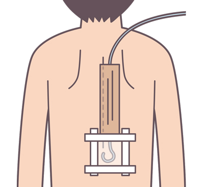 硬膜外麻酔の準備・介助（カテーテル留置法） | ナース専科