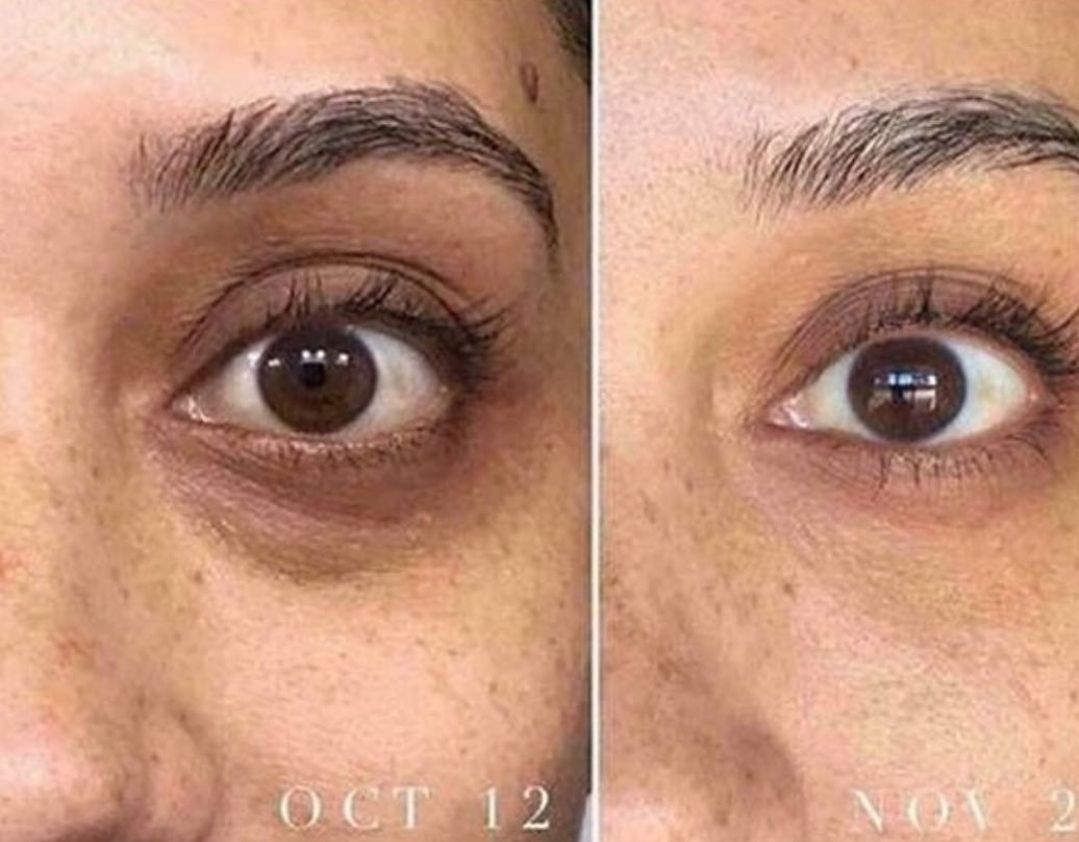 アワード賞 RODAN＋FIELDS☆目の下たるみ、クマ改善アイクリーム