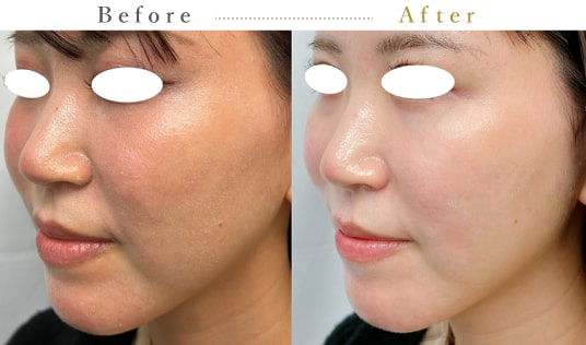 糸リフト（スレッドリフト）ならクリニーク大阪心斎橋｜切らずにリフト