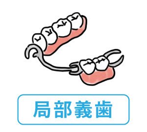 義歯の種類 ｜入れ歯・ブリッジ・歯科インプラント - LIFULL 介護