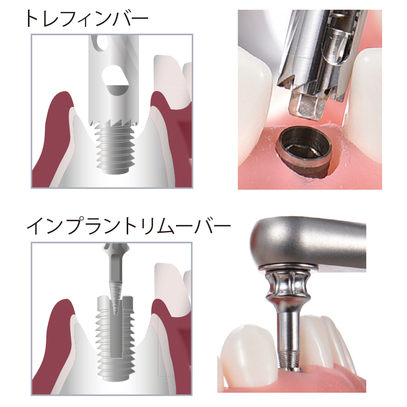 インプラントリムーバーキットの通販 | CiモールLABO | Ciモール