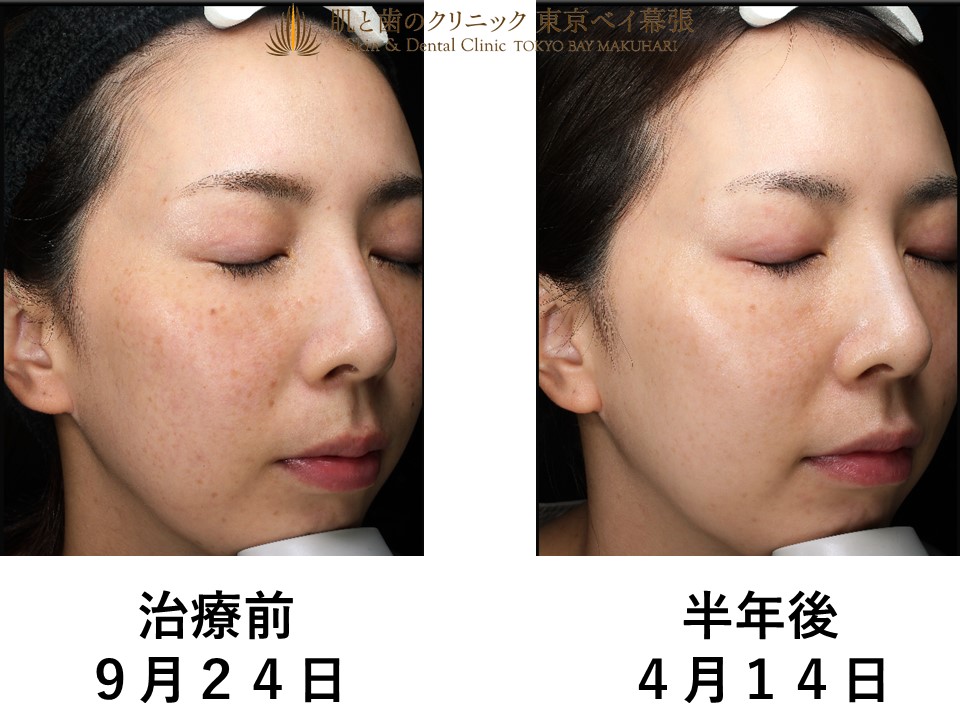 症例写真 | 肌の色むら・赤みの改善・毛細血管の改善に最適なエクセルV