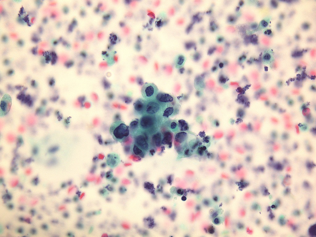 尿細胞診別府カンファレンス in 唐津