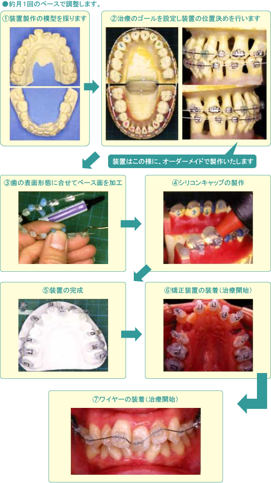 矯正歯科｜茨城県守谷市｜橋本歯科医院