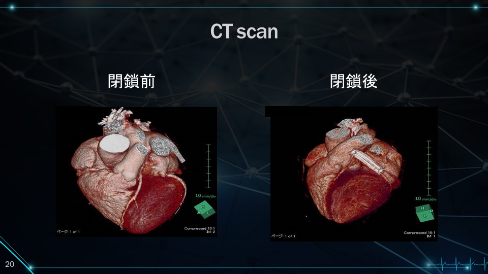 心房細動 | 国際ハートスリープクリニックつくば