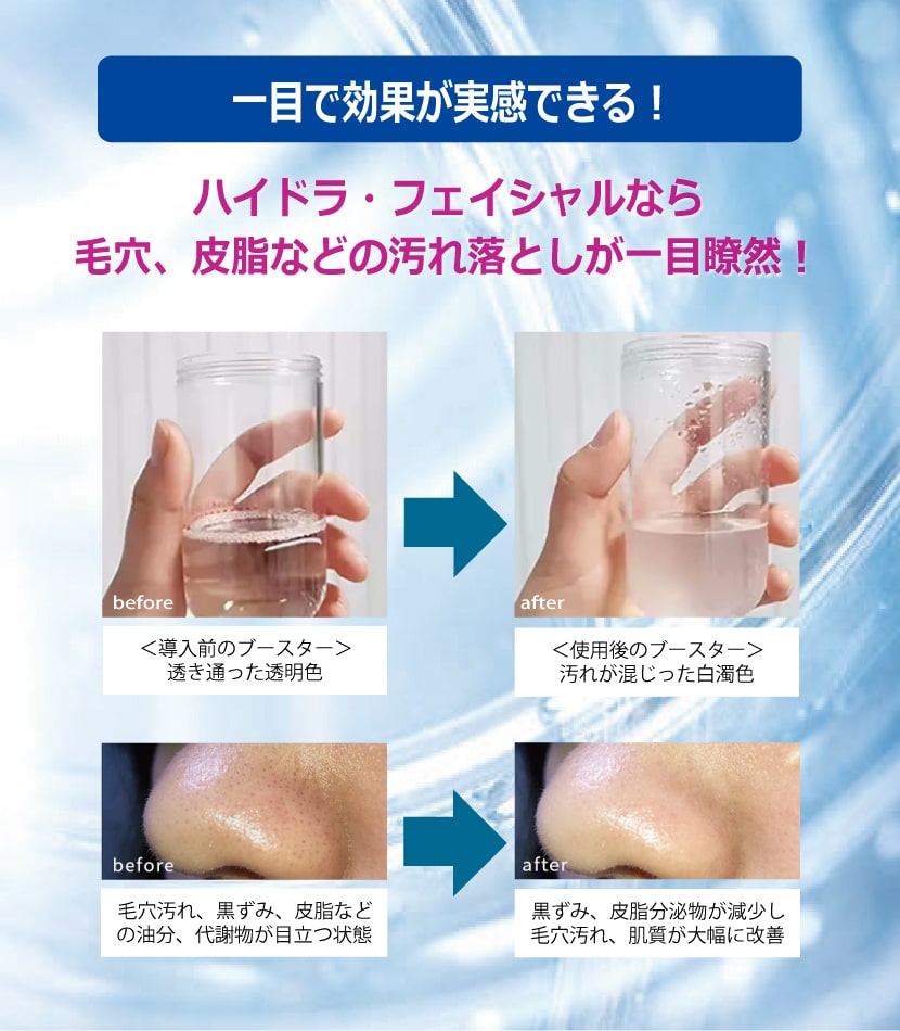 ハイドラ・フェイシャル／メニュー・料金｜毛穴（皮脂）洗浄・黒ずみ