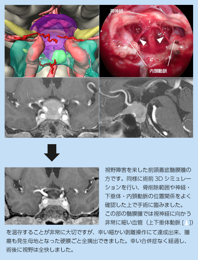 髄膜種について