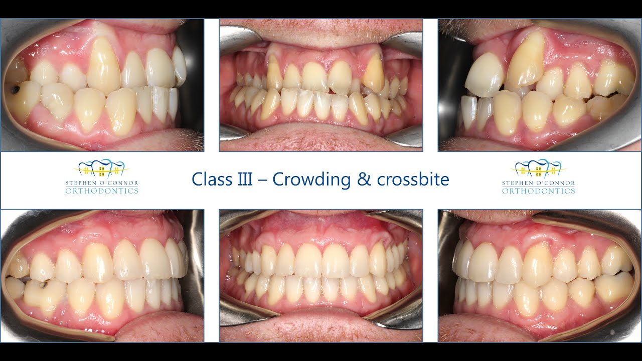 Class III occlusion - TADs & Labial ceramic braces & removal of
