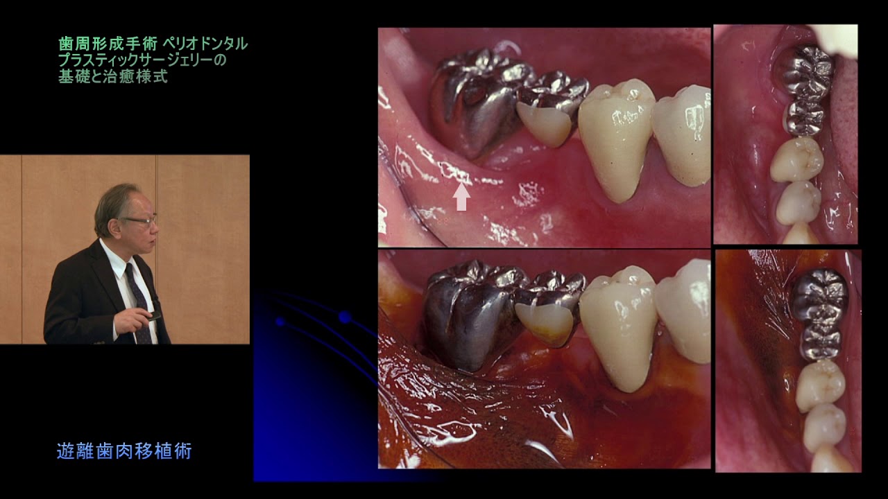 プラスティックサージェリーを究める～遊離歯肉移植・結合組織移植の