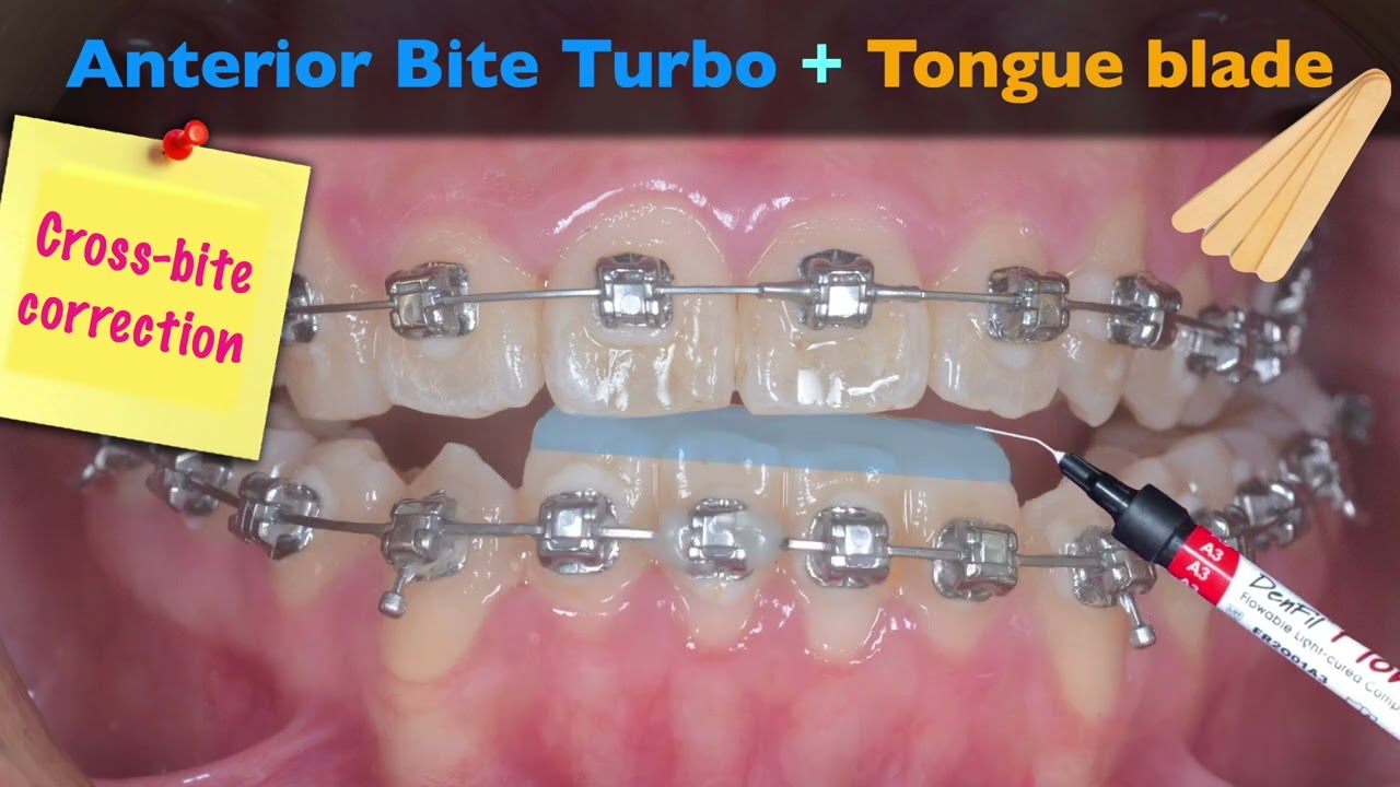 Skeletal Class III with nonsurgical treatment｜【Chris Chang Ortho