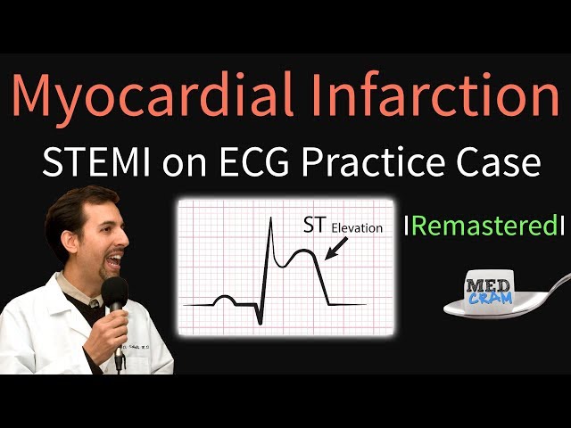 Myocardial Infarction / STEMI on ECG - Practice EKG - YouTube