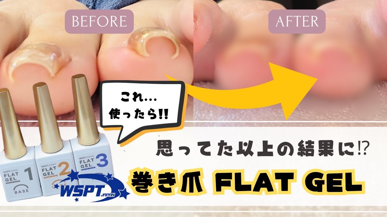 手軽に巻き爪ケアができるジェル！？検証しながらネイルチェンジします