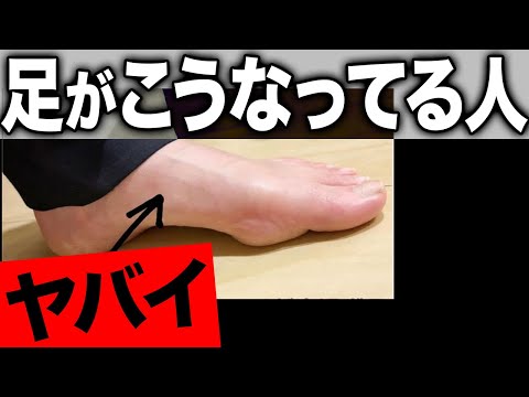 This arch is terrible! The negative effects of high arches and how