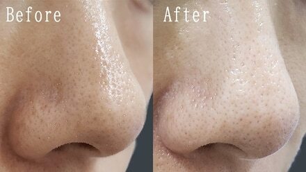 ハイドラフェイシャル | 表参道メディカルクリニック | ホットペッパー