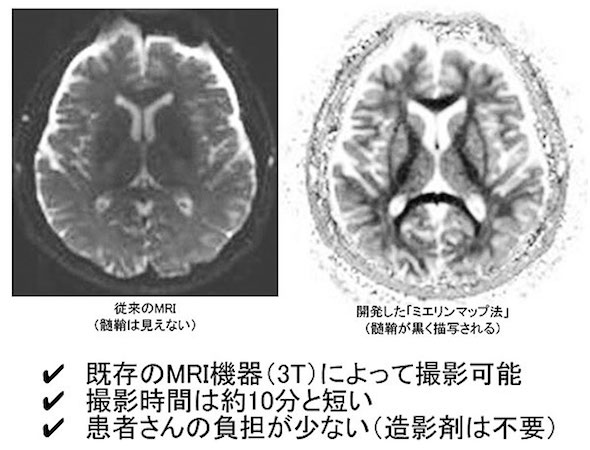 脳脊髄の髄鞘再生をMRIで可視化する手法を開発：医療技術ニュース