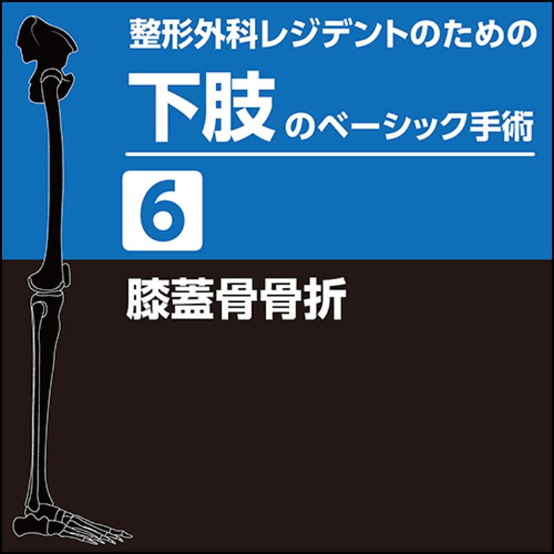 整形外科レジデントのための下肢のベーシック手術6 膝蓋骨骨折（PDF版