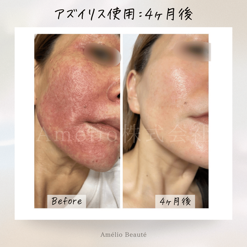 アズイリス 【As_iris】 炭酸ガスペーストパック 経皮吸収剤