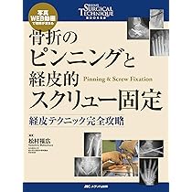 骨折のピンニングと経皮的スクリュー固定： 経皮テクニック完全攻略