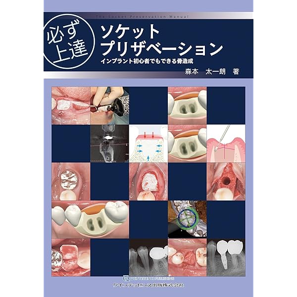 長期症例に学ぶパーシャルデンチャー | 中川 昌樹 |本 | 通販 | Amazon
