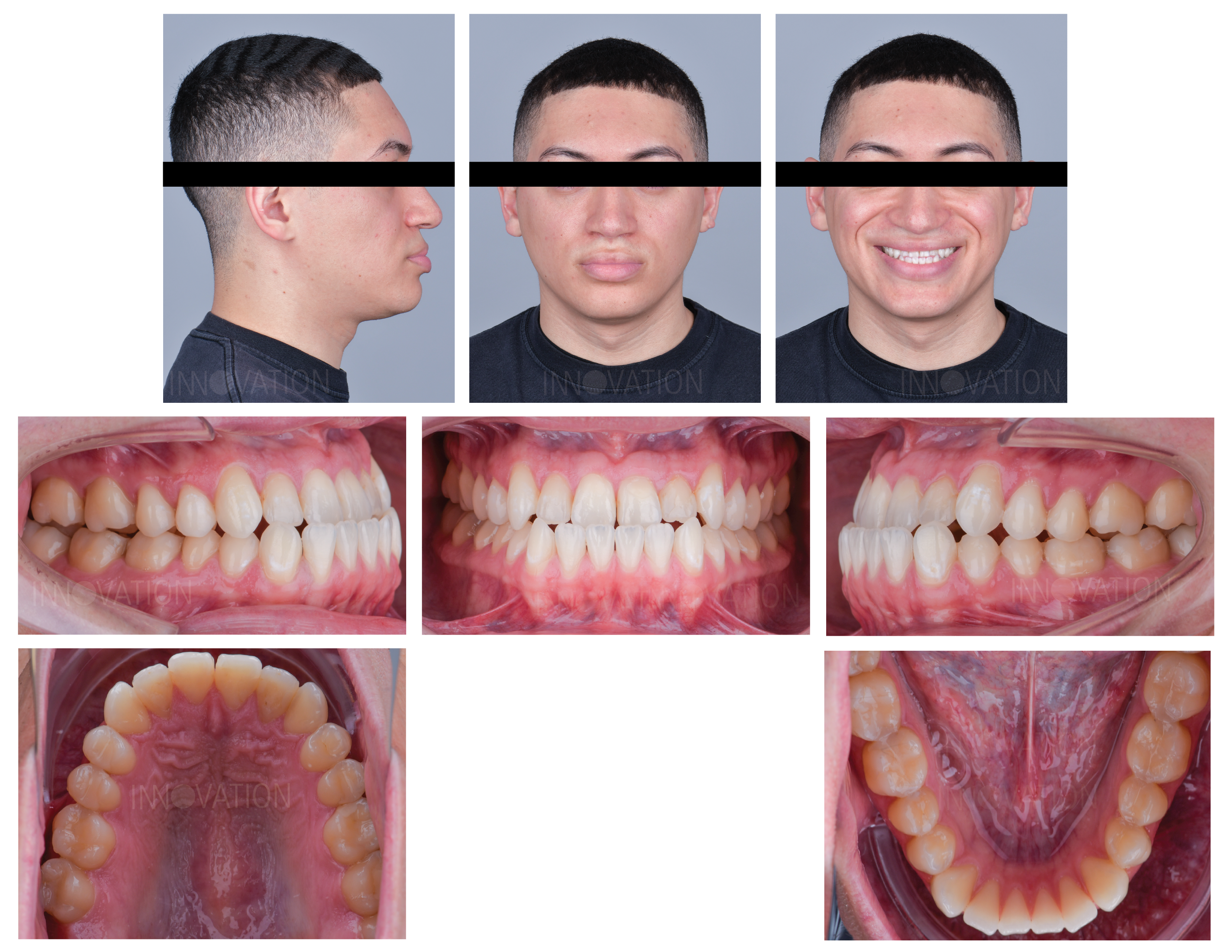 INNOVATION | Correction of Skeletal Class III Malocclusion in