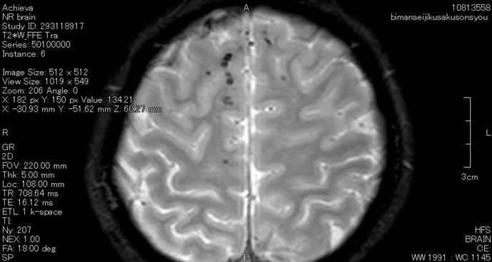 7 頭部外傷 びまん性軸索損傷、 diffuse axonal injury、DAI | 交通
