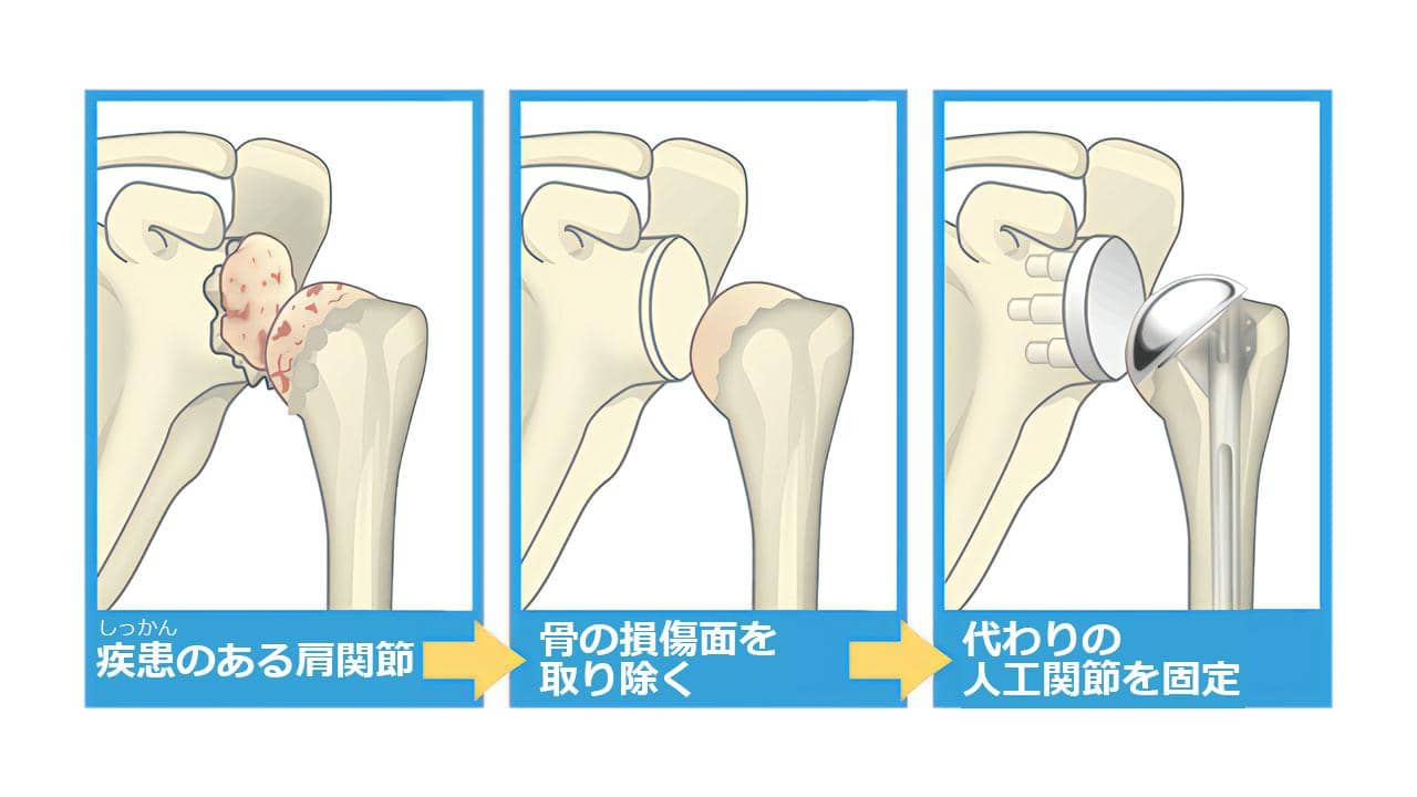 変形性肩関節症の人工肩関節全置換術、リバース型人工肩関節全置換術