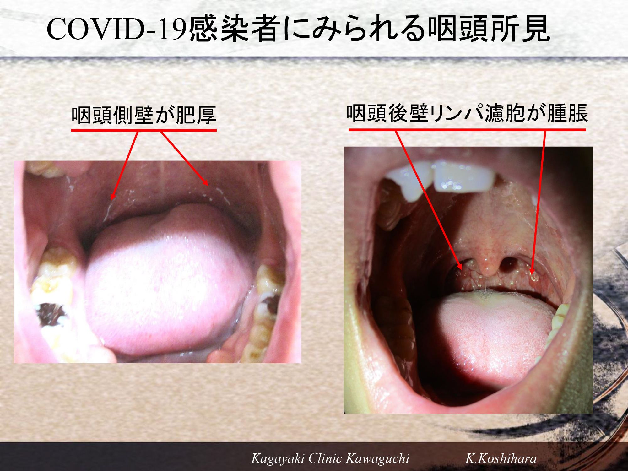 新型コロナ、特徴ある咽頭所見の推移とでやすい背景｜かがやき