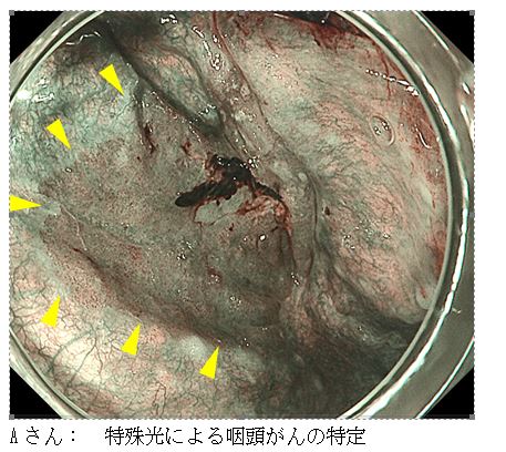 咽頭（のど）、食道がんの早期発見と内視鏡治療について ｜ 公益財団