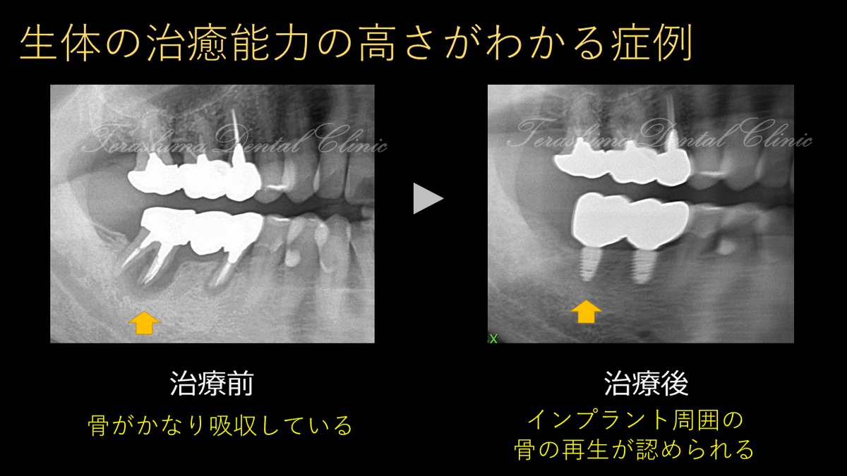 生体の治癒能力の高さがわかるインプラント症例~77歳男性~ | 箕面市の