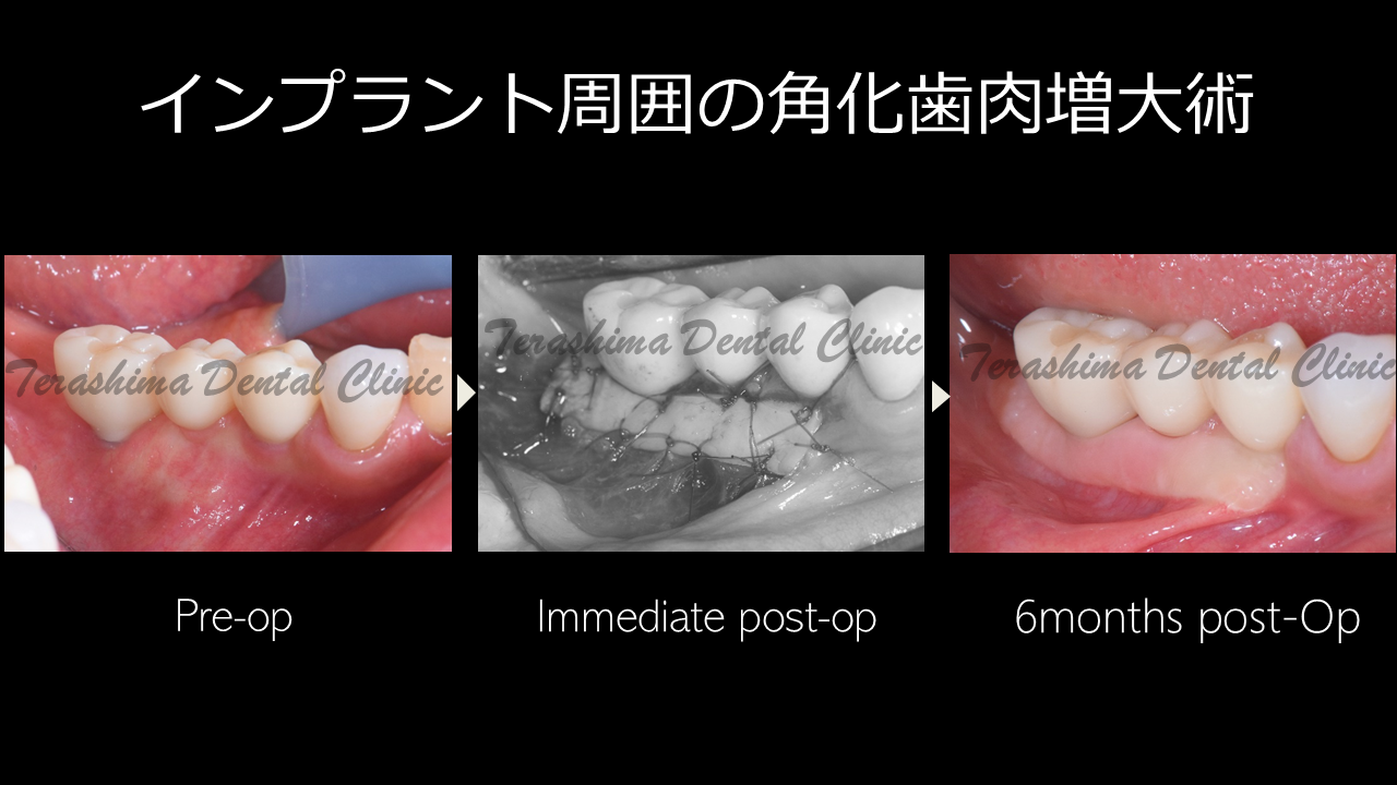 歯肉の移植術~遊離歯肉移植術~インプラント | 箕面市の歯医者【寺嶋