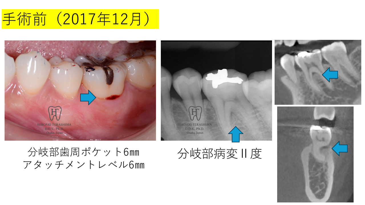 Ⅱ度分岐部病変に対する再生療法で長期安定を得た症例（左下6番・7年7