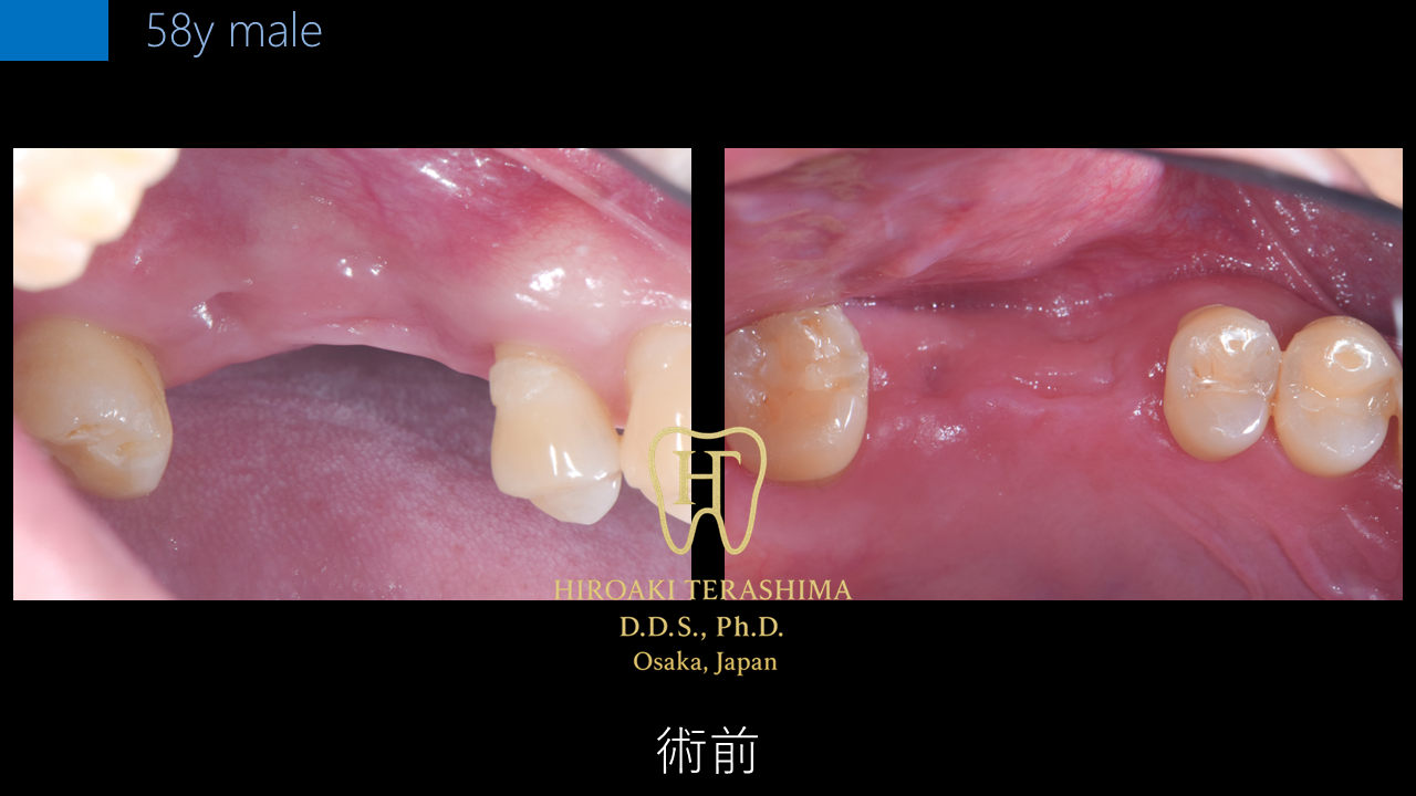 骨がほとんどない上顎奥歯に対するインプラント治療 ― 既存骨1mm以下