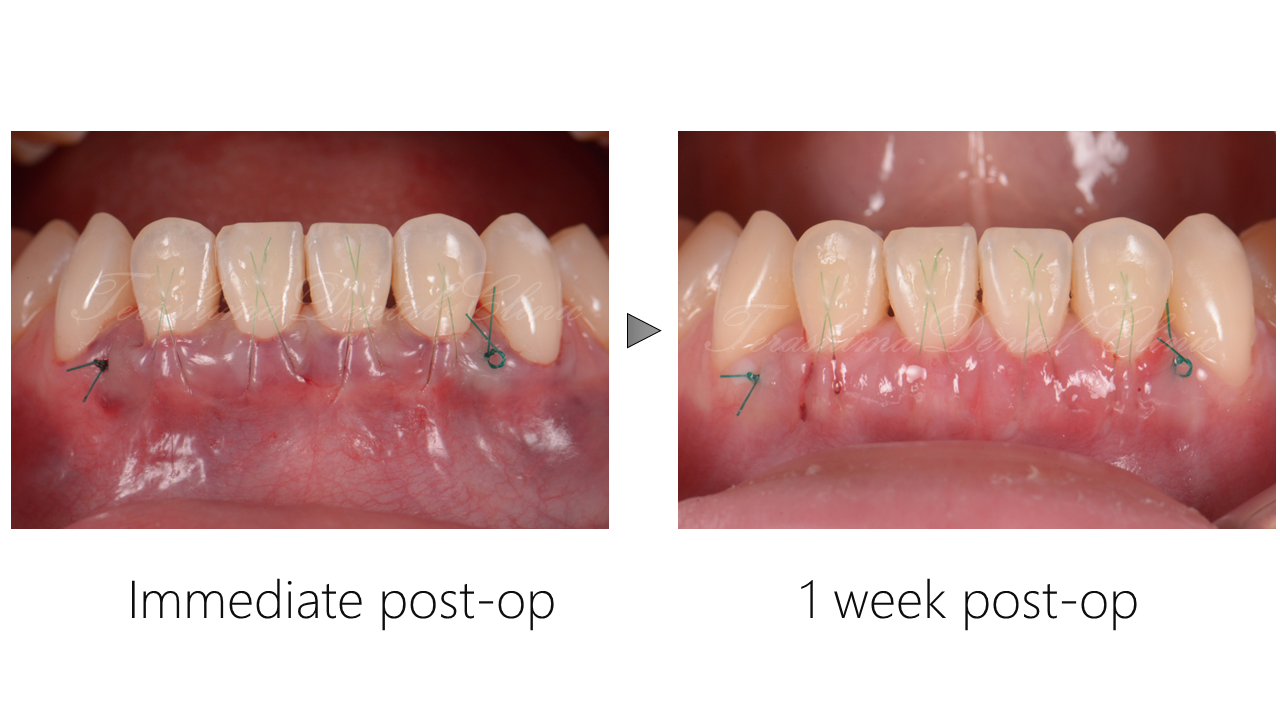 歯肉退縮への根面被覆術~ブラックトライアングルも少し改善したケース