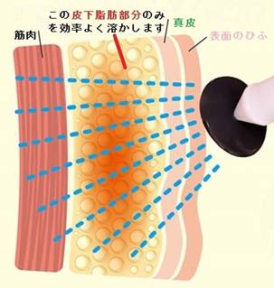 高周波 （RF ラジオ波） 顔・ボディーの部分痩身 脂肪吸引のおてがる版