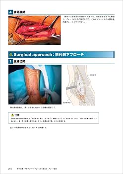 骨折治療 手術アプローチがよくわかる髄内釘・プレート固定 | 渡部 欣