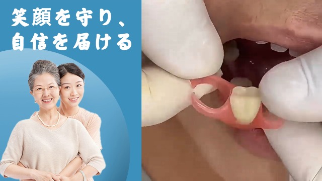 Amazon.co.jp: Miraila カスタム入れ歯 6本 部分 義歯 仮歯 差し歯対応