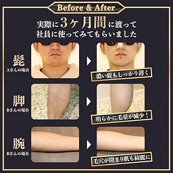 Amazon | MCLEAR メンズクリア ホームクリア MAX 脱毛器 メンズ 限定