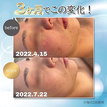 Amazon.co.jp: 炭酸パック ジェル 約120回 2ヶ月分 大容量 100g 炭酸