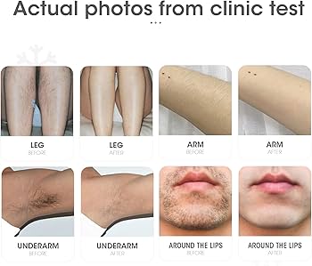 Amazon.com: DEESS IPL Laser Hair Removal Device for Women & Men