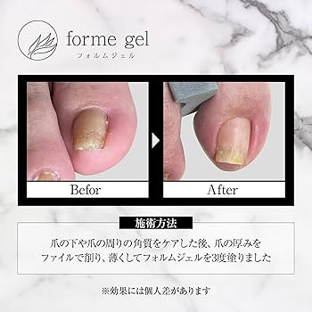 Amazon | フォルムジェル 誰でも簡単！塗るだけ！巻き爪ケアジェル