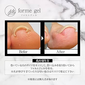 Amazon | 簡単塗るだけ巻き爪ケアジェル/フォルムジェル