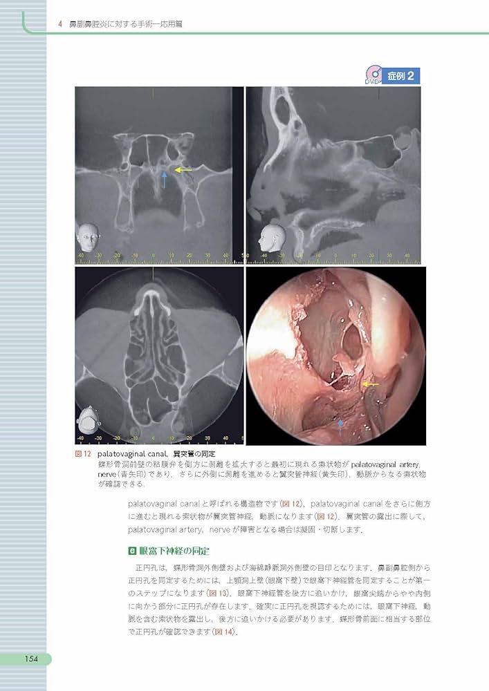 内視鏡下鼻副鼻腔・頭蓋底手術 [3DCT画像データDVD-ROM付]: CT読影と