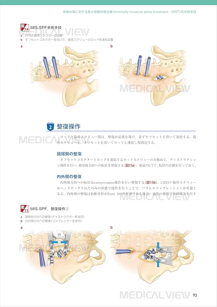 最小侵襲脊椎外科［Web動画付］ (新OS NEXUS No.11) | 佐藤 公治 |本