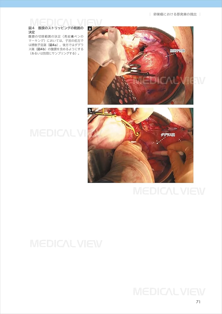 明日からできる卵巣がん手術［Web動画付］ (OGS NOW basic 12) | 万代