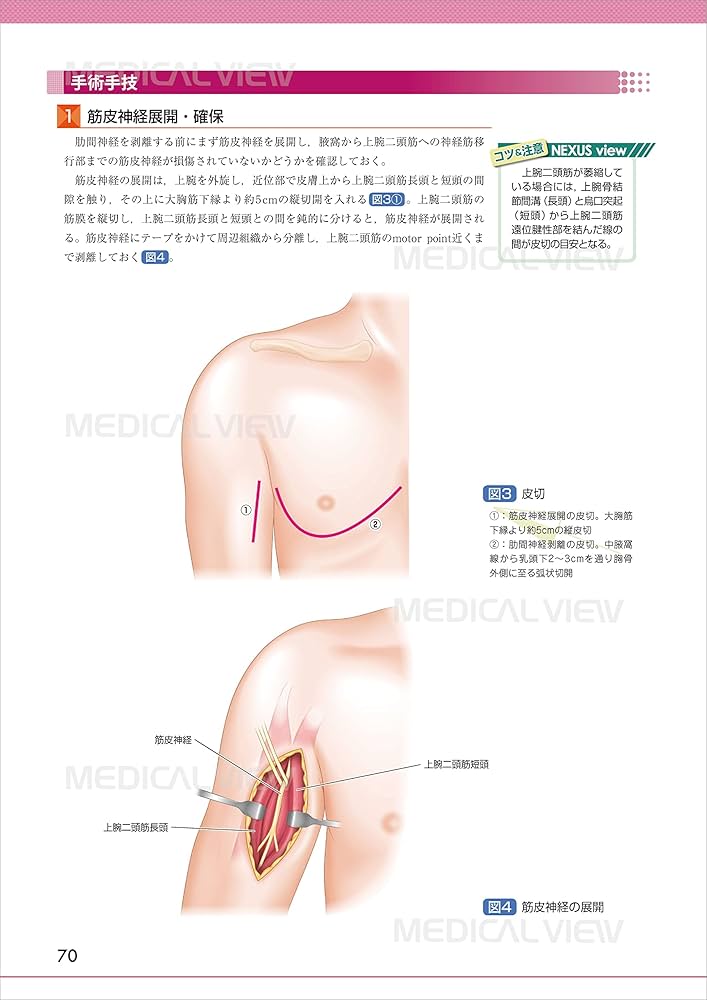 末梢神経障害・損傷の修復と再建術 (OS NEXUS(電子版付き) 17) | 岩崎