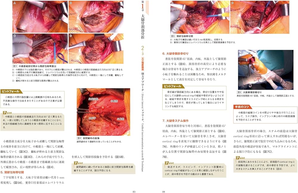 大腿骨近位部骨折：大腿骨頚部・転子部・転子下骨折の手術手技 (整形
