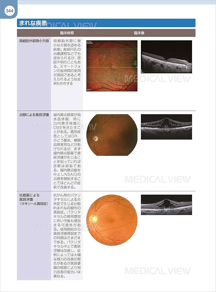 網膜診療クローズアップ 改訂第2版 | 柳 靖雄 |本 | 通販 | Amazon