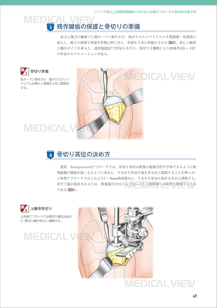 上肢の人工関節手術［Web動画付］ (新OS NEXUS No.5) | 今井 晋二 |本