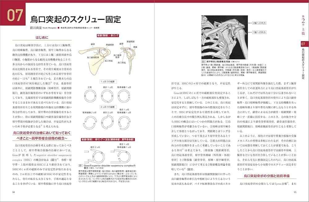 骨折のピンニングと経皮的スクリュー固定： 経皮テクニック完全攻略